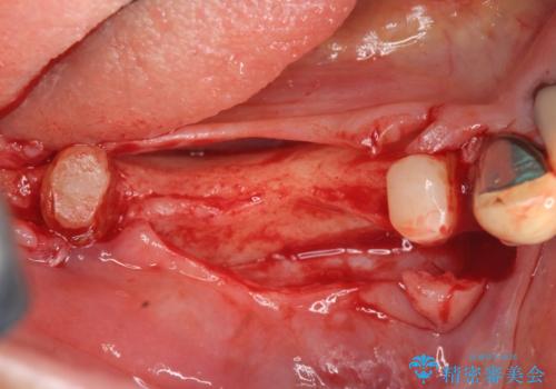 薄い骨幅 骨造成 歯肉移植を併用したインプラント治療の治療前
