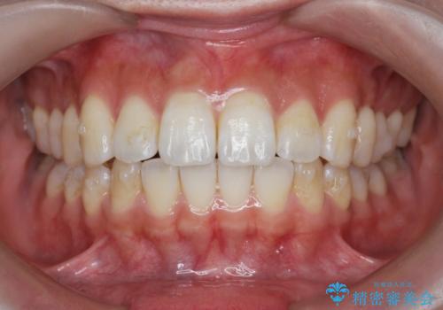 数ヶ月で、わずかな歯並びの修正に対応するインビザラインライト治療の治療中