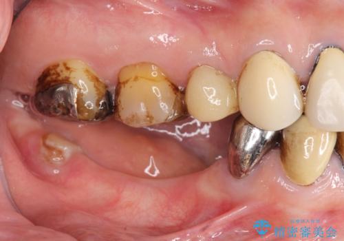 薄い骨幅 骨造成 歯肉移植を併用したインプラント治療の治療前