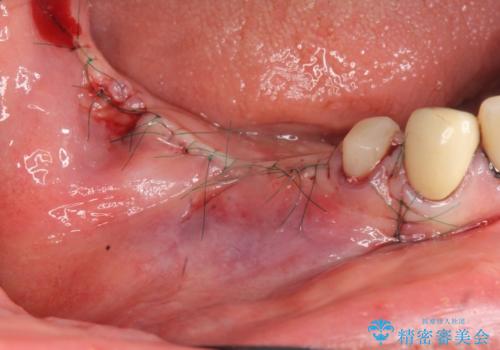 薄い骨幅 骨造成 歯肉移植を併用したインプラント治療の治療前