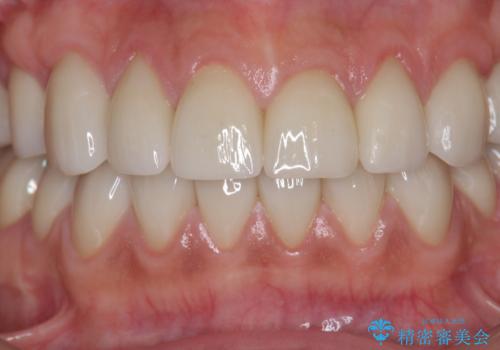 歯ぎしりですり減った 前歯の見た目を回復したいの症例 治療後