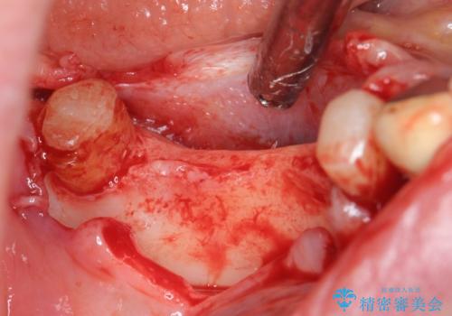 薄い骨幅 骨造成 歯肉移植を併用したインプラント治療の治療前