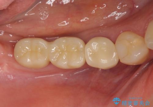 インプラント治療による咬合機能回復の治療後