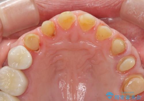 歯ぎしりですり減った 前歯の見た目を回復したいの治療中