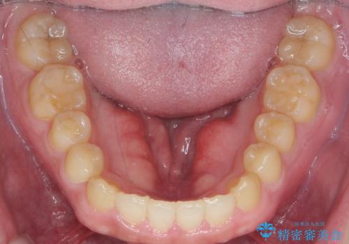 インビザラインで行うカモフラージュ矯正の治療後