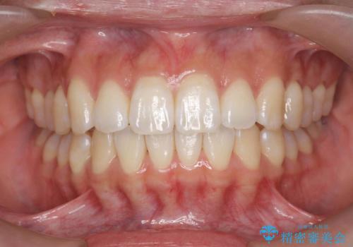 数ヶ月で、わずかな歯並びの修正に対応するインビザラインライト治療の症例 治療後