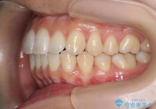数ヶ月で、わずかな歯並びの修正に対応するインビザラインライト治療の治療後