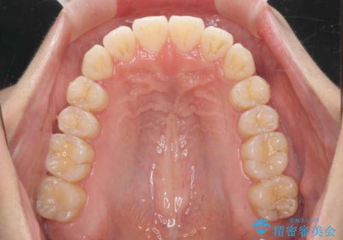 数ヶ月で、わずかな歯並びの修正に対応するインビザラインライト治療の治療後
