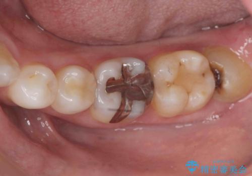 目立つ銀歯を自然にしたいの治療前