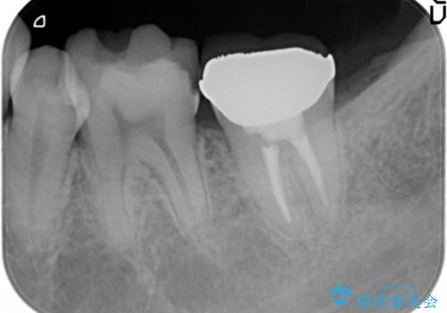 内側に生えている歯をなんとかしたい 矯正は嫌 30代男性の治療前