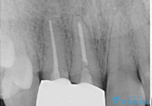 一度諦めた矯正にチャレンジしたい インビザラインとセラミック治療の治療前