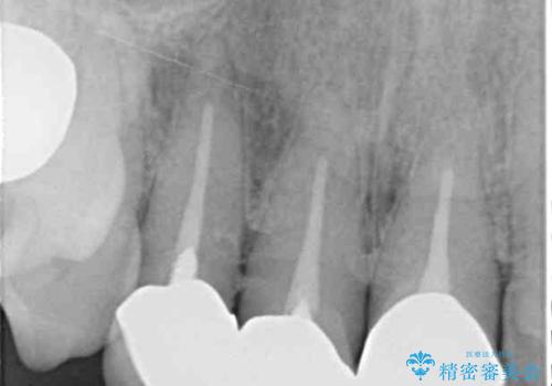歯茎の縁に見える変色を隠したい 前歯のオールセラミッククラウンの治療前