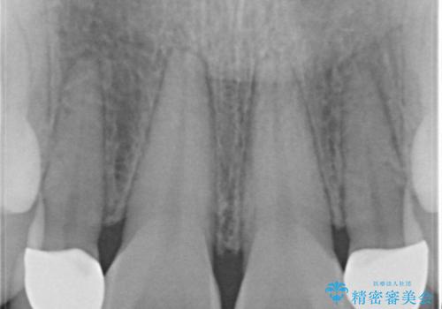 矮小歯を綺麗な歯に。矯正とセラミックの総合治療の治療後