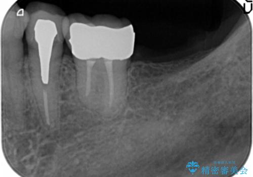 親知らずの移植 4年半経過症例 70代女性の治療後