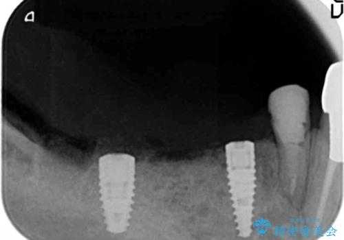 薄い骨幅 骨造成 歯肉移植を併用したインプラント治療の治療中