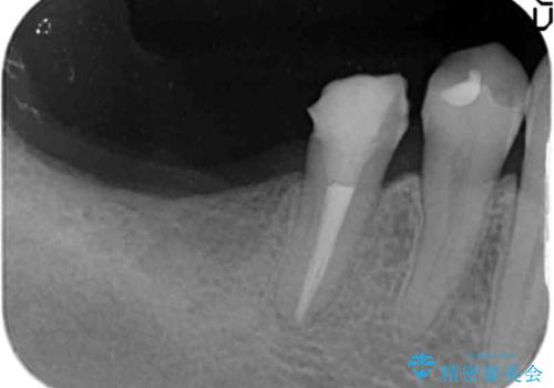 インプラント治療による咬合機能回復の治療中
