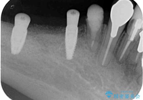 薄い骨幅　骨造成　歯肉移植を併用したインプラント治療の治療中