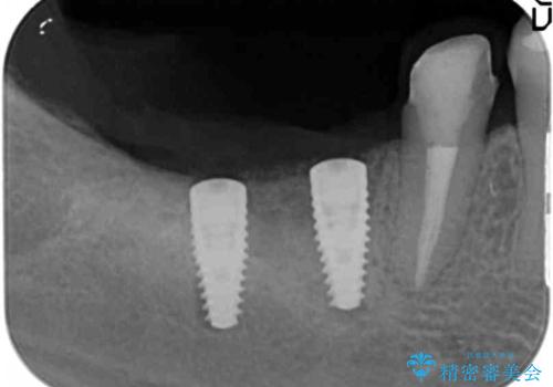 インプラント治療による咬合機能回復の治療中