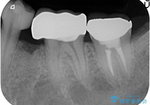 内側に生えている歯をなんとかしたい 矯正は嫌 30代男性の治療後