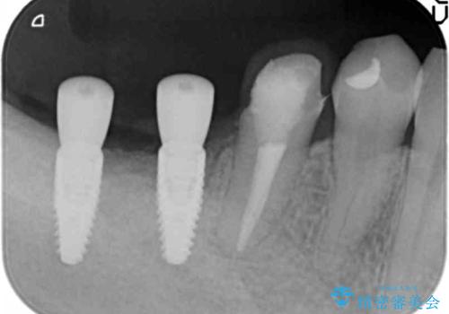 インプラント治療による咬合機能回復の治療中
