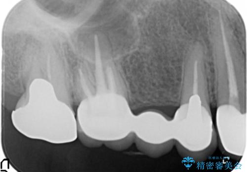 かぶせものと歯ぐきの境目が黒い 40代女性の治療前