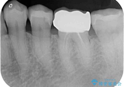 [ セラミック治療 ]目立つ奥歯の銀歯を白くするの治療後