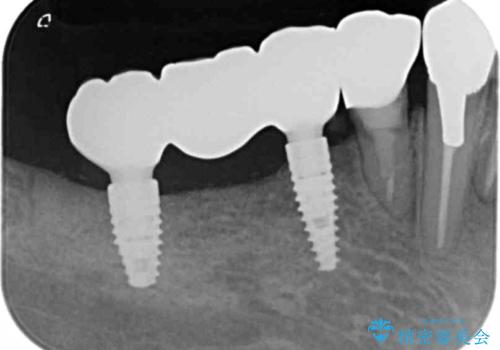 薄い骨幅　骨造成　歯肉移植を併用したインプラント治療の治療後