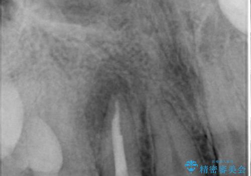 前歯の色と隙間が気になる 早く治したい 矯正は嫌 30代女性の治療後