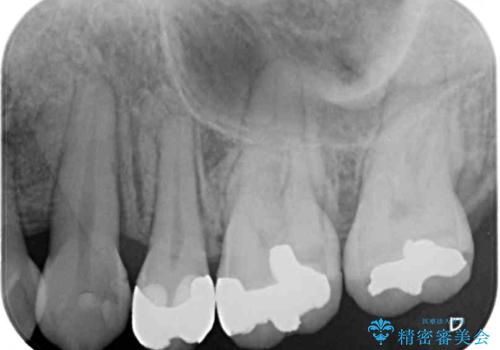 目立つ銀歯を白くしたい 奥歯のセラミック治療の治療前