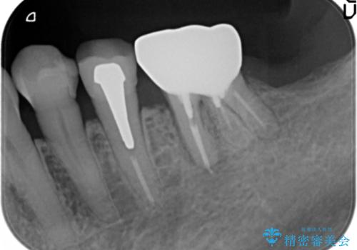 親知らずの移植 4年半経過症例 70代女性の治療前