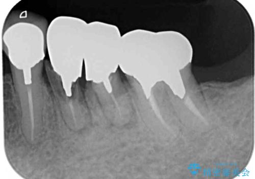 抜かずに保存した奥歯が痛くて臭う セラミックブリッジによる欠損補綴治療の治療前