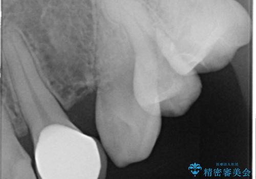 前歯の色と隙間が気になる 早く治したい 矯正は嫌 30代女性の治療後
