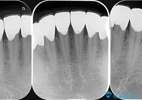 歯ぎしりですり減った 前歯の見た目を回復したいの治療後