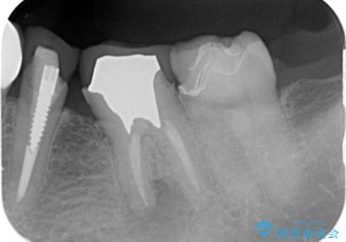 古い被せ物をセラミックにしたい 40代男性の治療前