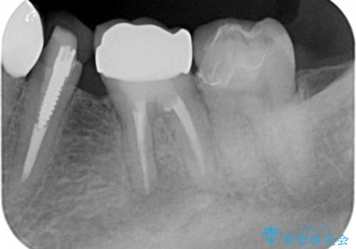 古い被せ物をセラミックにしたい 40代男性の治療後