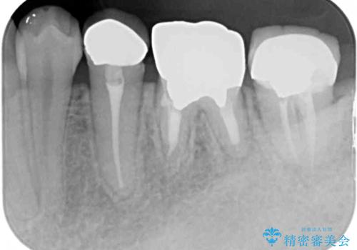 目立つ銀歯を白くしたい 奥歯のセラミック治療の治療前