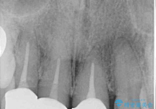 歯茎の縁に見える変色を隠したい　前歯のオールセラミッククラウンの治療後