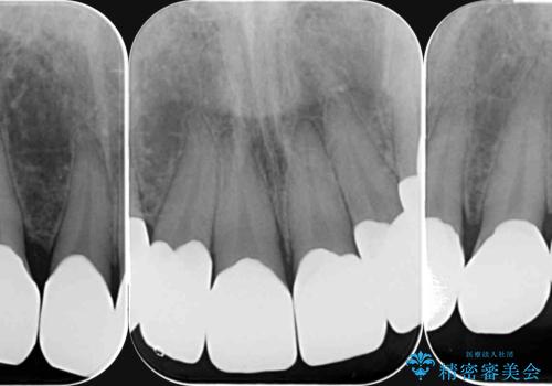 歯ぎしりですり減った 前歯の見た目を回復したいの治療後