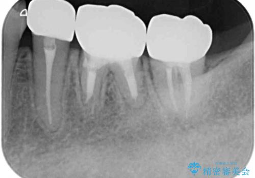 目立つ銀歯を白くしたい 奥歯のセラミック治療の治療後