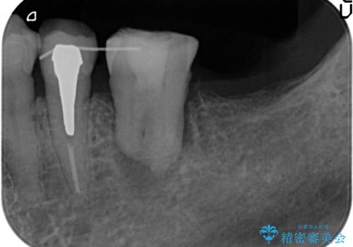 親知らずの移植 4年半経過症例 70代女性の治療中