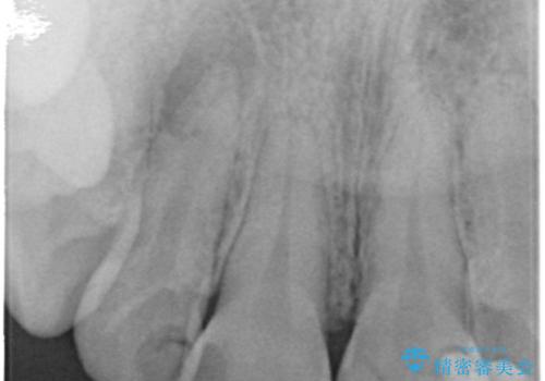 前歯の色と隙間が気になる 早く治したい 矯正は嫌 30代女性の治療前