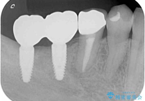 インプラント治療による咬合機能回復の治療後