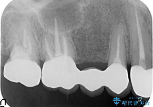 かぶせものと歯ぐきの境目が黒い 40代女性の治療後