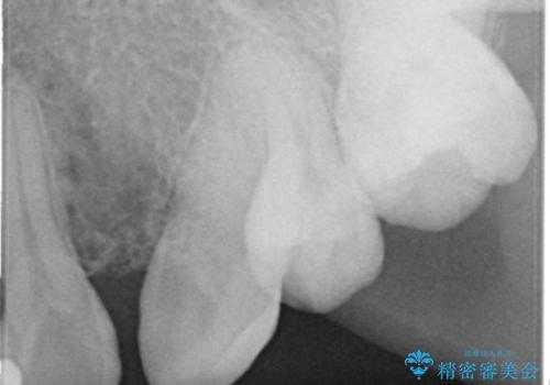 前歯の色と隙間が気になる 早く治したい 矯正は嫌 30代女性の治療前