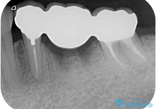 抜かずに保存した奥歯が痛くて臭う セラミックブリッジによる欠損補綴治療の治療後