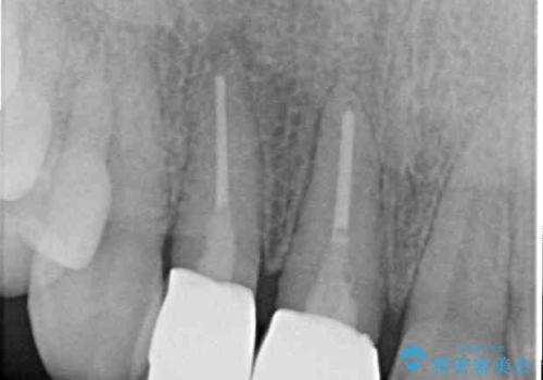 一度諦めた矯正にチャレンジしたい インビザラインとセラミック治療の治療後