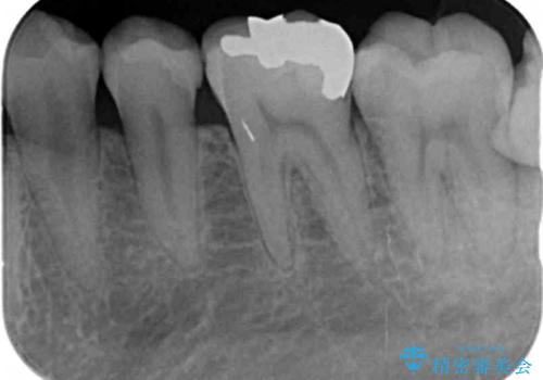 目立つ銀歯を自然にしたいの治療前