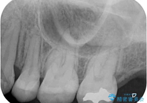 目立つ銀歯を白くしたい 奥歯のセラミック治療の治療後