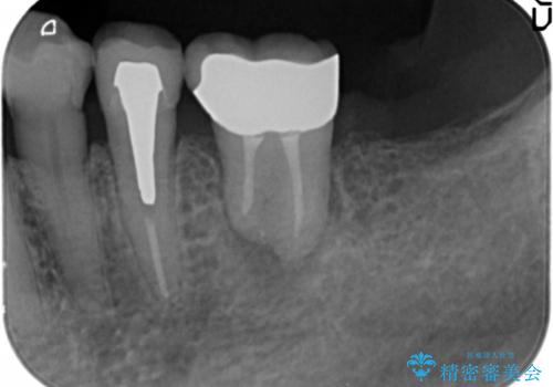 親知らずの移植 4年半経過症例 70代女性の治療中