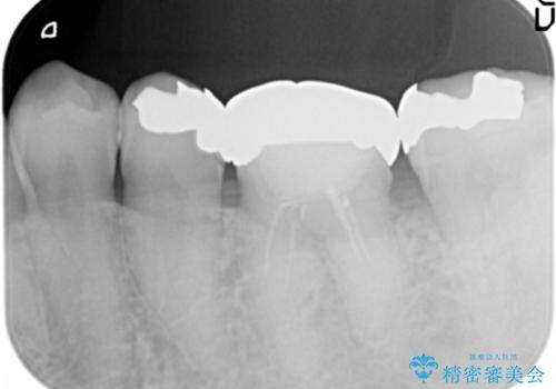 [ セラミック治療 ]目立つ奥歯の銀歯を白くするの治療前